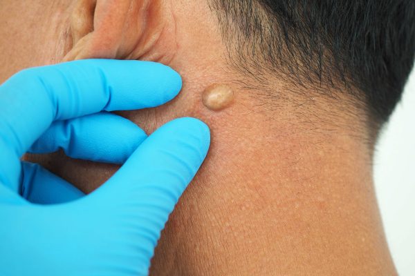 Can You Remove a Cyst Without Surgery?