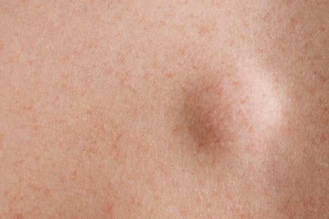 Can a Lipoma Ever Turn Cancerous? 1 Lipoma