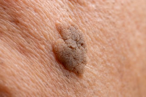 Seborrheic Keratosis Removal