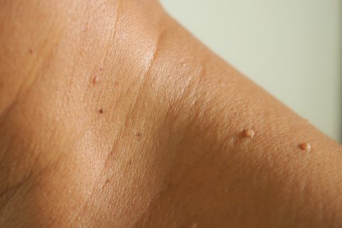 Skin Tag Removal