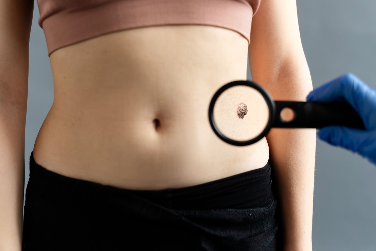 Mole Removal: Cost, Procedure, Scarring & Recovery Guide