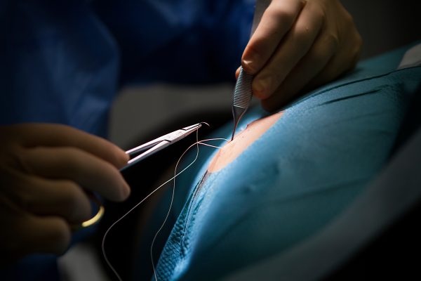 How Painful Is Lipoma Removal Surgery?