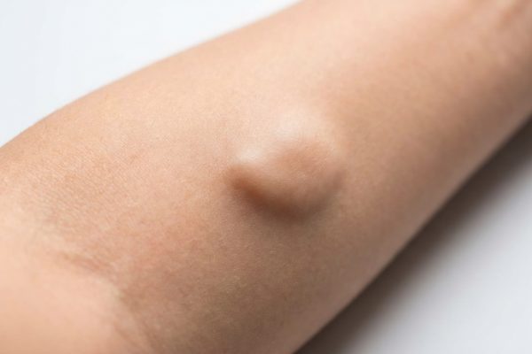 At What Size Should a Lipoma Be Removed?